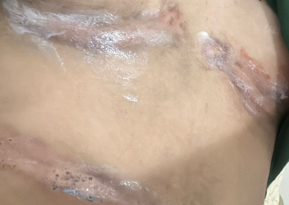'Sai para me divertir e voltei machucada', diz jovem que sofreu queimaduras durante festa no interior de SE