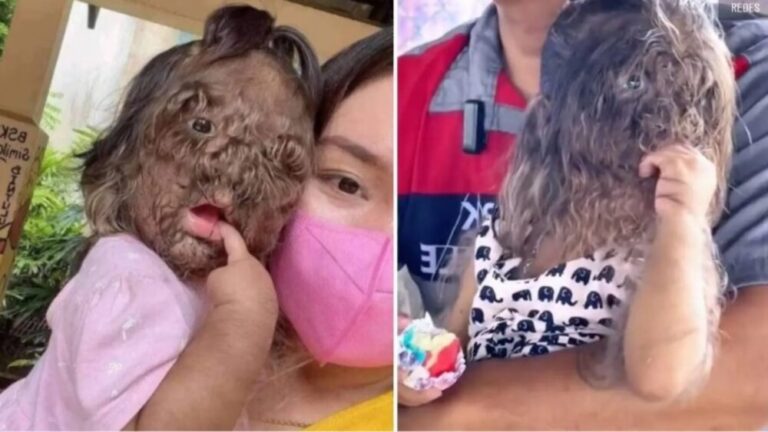 Menina sofre de 'síndrome do lobisomem'; pais querem desmistificar doença, veja vídeo