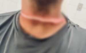 Motociclista fica ferido ao ser atingido por fio no trânsito em Aracaju